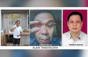 Operasi Mata Berujung Buta, Oknum Dokter RSMM Jatim Dilaporkan ke Polda